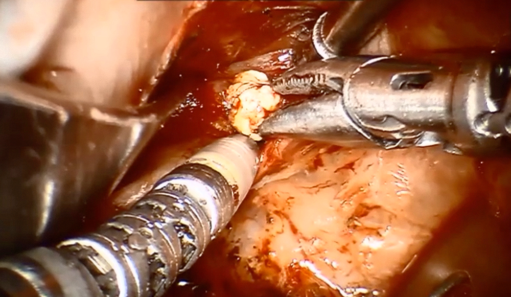 a sialendoscopic-transoral robotic procedure to remove a large salivary stone.